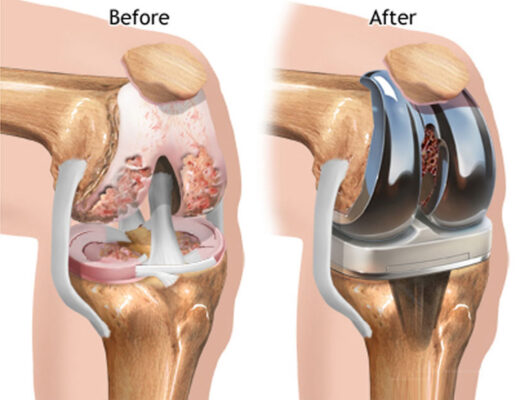 kneed replacement surgery