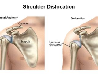 shoulder dislocation surgery Ghaziabad Delhi NCR