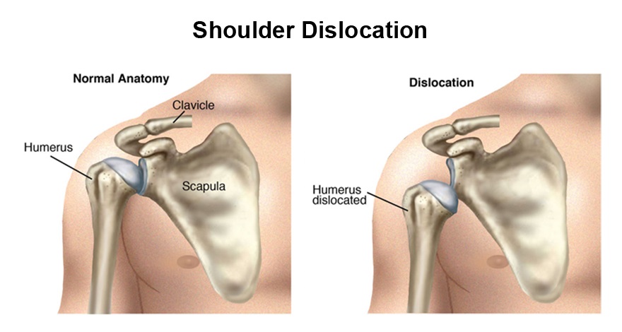 shoulder dislocation surgery Ghaziabad Delhi NCR
