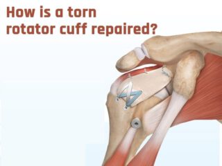 Rotor Cuff Surgery in Indirapuram