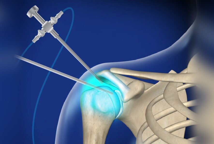 Shoulder Surgery Cost in India